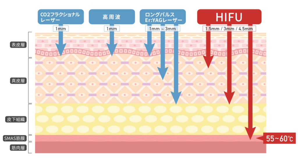 腟HIFU「Gold Ultra Vera」日本初の輸入販売取り扱い開始